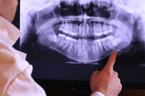 Best Emergency Wisdom Teeth Removal in Elmhurst, IL